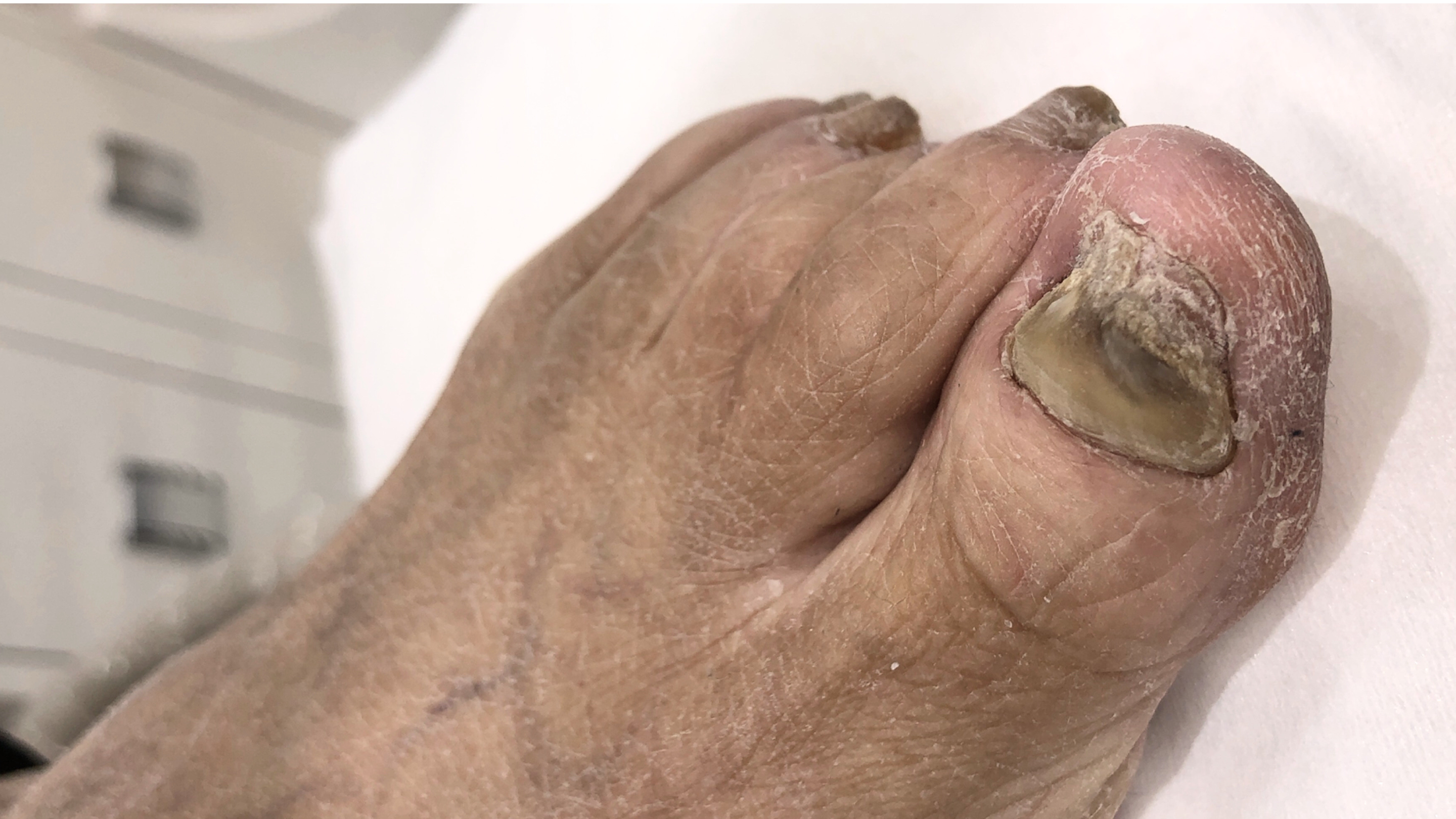 1 pair Silica gel Toe Nail Tools Reusable Finger Bracket Nail & Toe se –  MakyNailSupply
